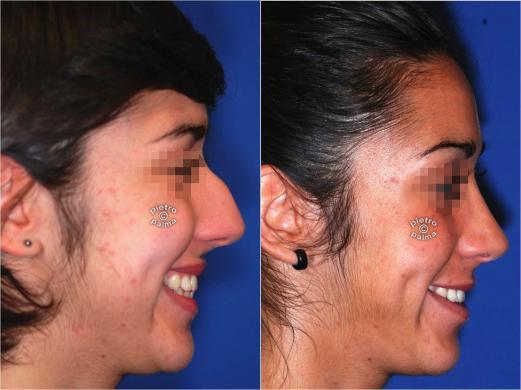 nose job before and after bump 1