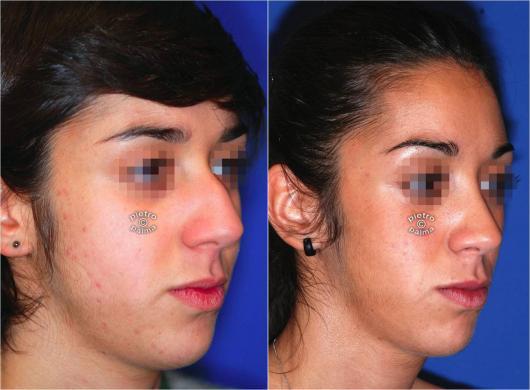 nose job before and after bump 2