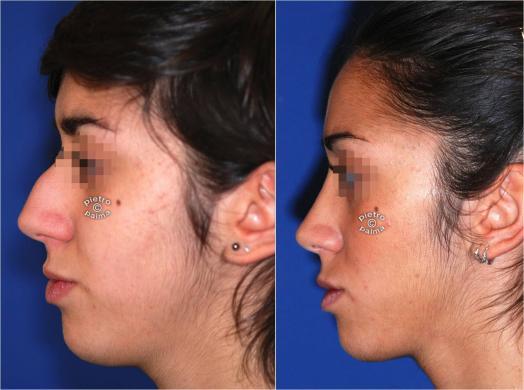 nose job before and after bump 4