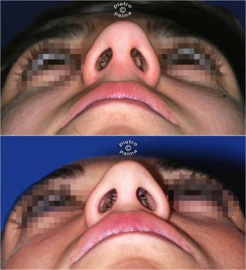 nose job before and after bump 9