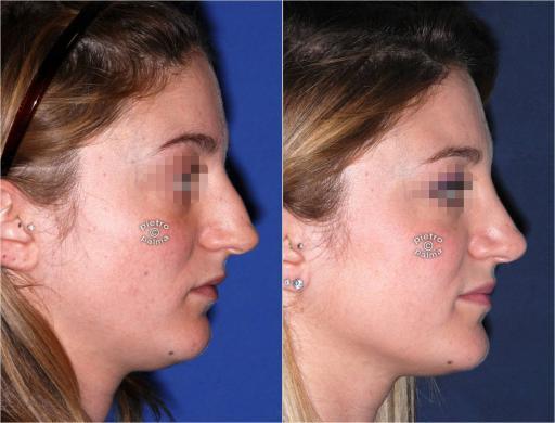 dorsal hump removal woman before and after 1