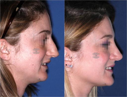 dorsal hump removal woman before and after 5