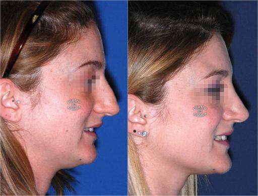 dorsal hump removal woman before and after