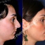 rhinoplasty hump removal before and after