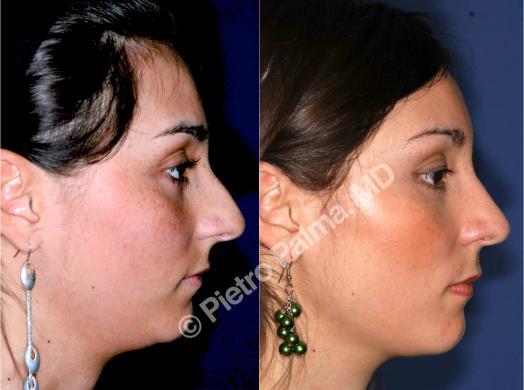 rhinoplasty hump removal before and after