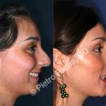 rhinoplasty hump removal before and after 1