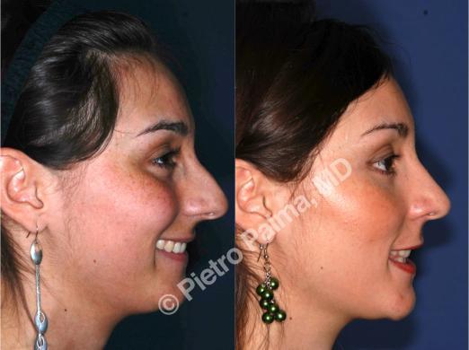 rhinoplasty hump removal before and after 1