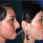 rhinoplasty hump removal before and after 2