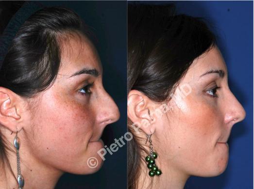 rhinoplasty hump removal before and after 2