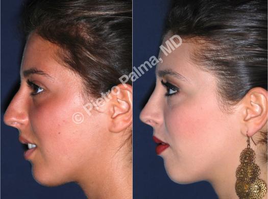 rhinoplasty before and after bump 1