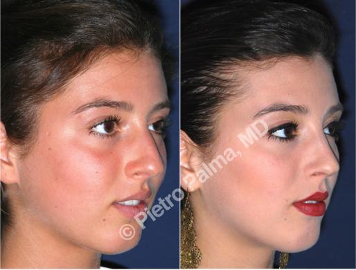 rhinoplasty before and after bump 2