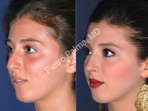 rhinoplasty before and after bump 4