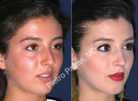 rhinoplasty before and after bump 3