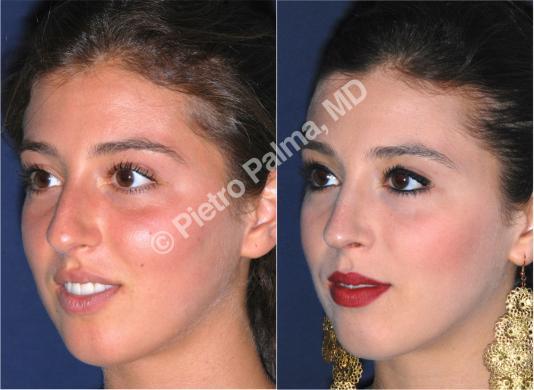 rhinoplasty before and after bump