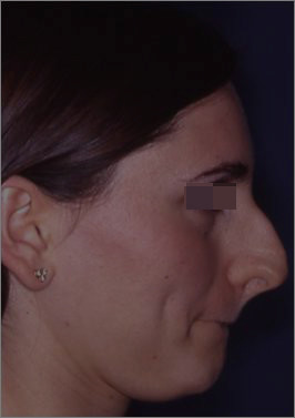 5over projected nose