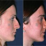 rhinoplasty before and after 7 day after