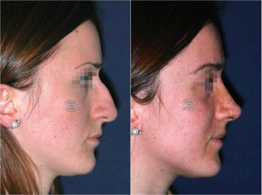 rhinoplasty before and after 7 day after