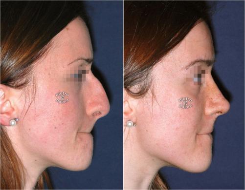 nose job before and 7 day after