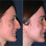 rhinoplasty before and after 7 day