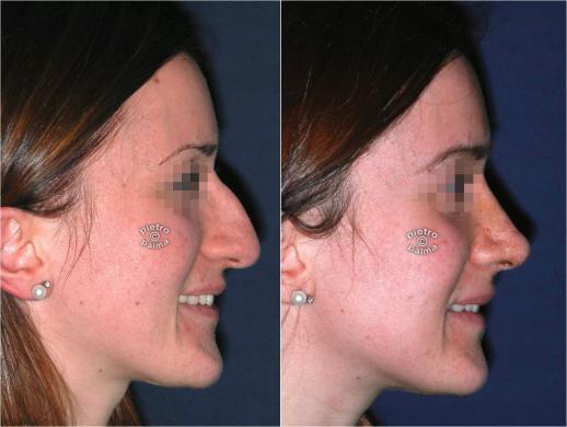 rhinoplasty before and after 7 day