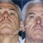 rhinoplasty before and after special cases 1