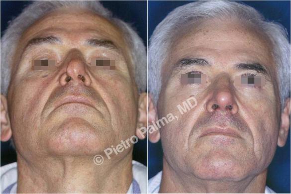 rhinoplasty before and after special cases 1