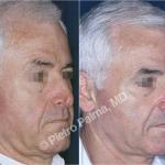 rhinoplasty before and after special cases 2