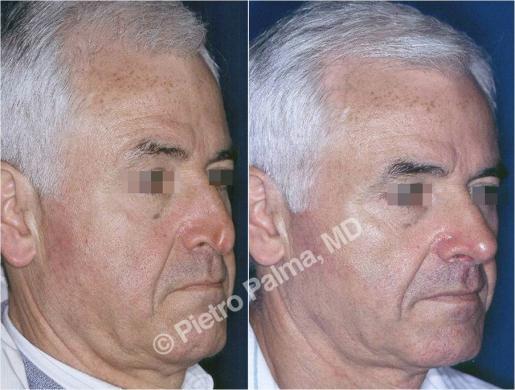 rhinoplasty before and after special cases 2