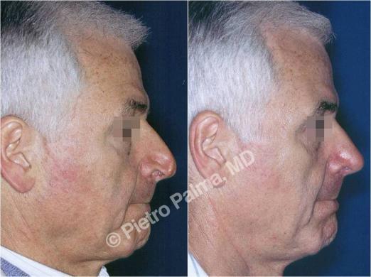 rhinoplasty before and after special cases 3