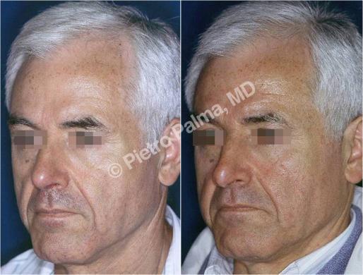 rhinoplasty before and after special cases 4