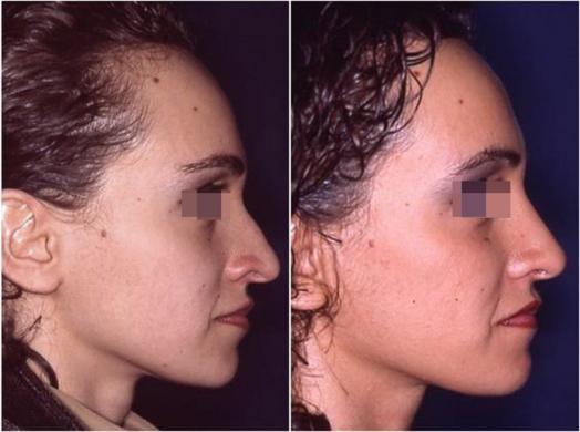 nose job before and after special cases woman 3