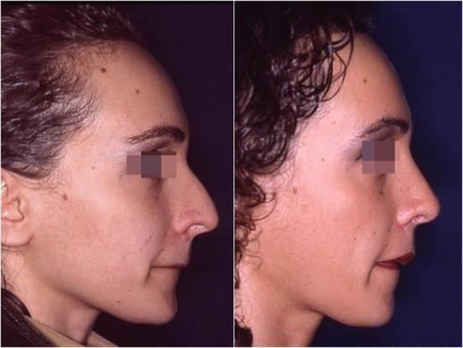 nose job before and after special cases woman 4