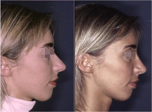 setto nasale deviato prima e dopo