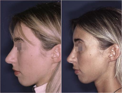 setto nasale deviato prima e dopo 1