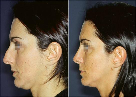 setto nasale deviato prima e dopo 3