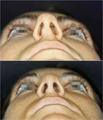 setto nasale deviato prima e dopo 4