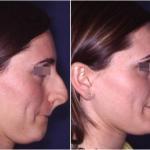 big nose to small nose rhinoplasty