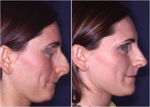 big nose to small nose rhinoplasty