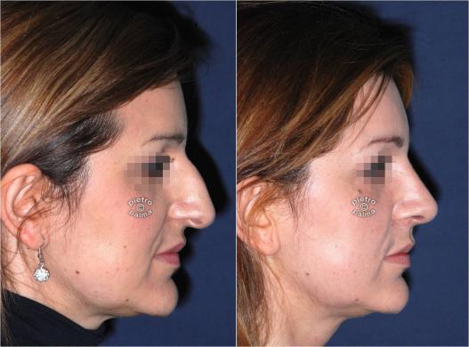 tip rhinoplasty before and after