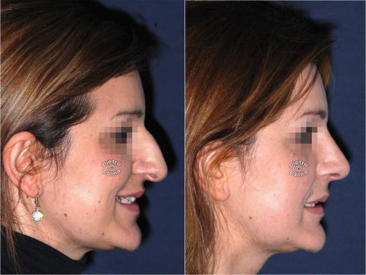 nasal tip plasty before and after