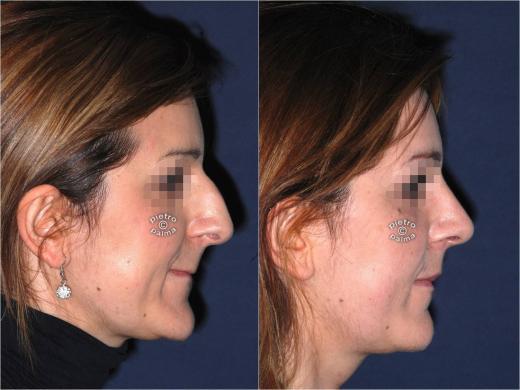 nose tip reduction before and after 1