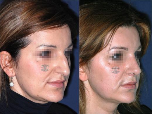 nose tip rhinoplasty before and after