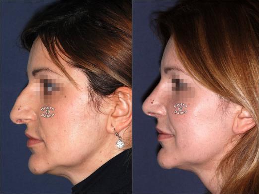 nose tip surgery before and after