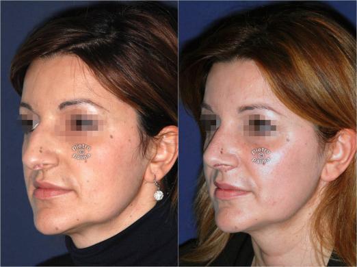 nose tip surgery before and after 1