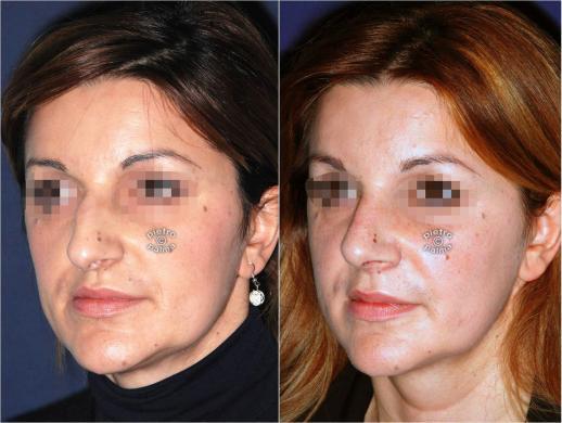 tip rhinoplasty before and after 1