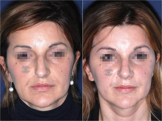 nose tip reduction before and after