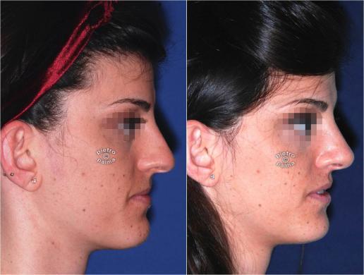 nose tip rhinoplasty before and after 1