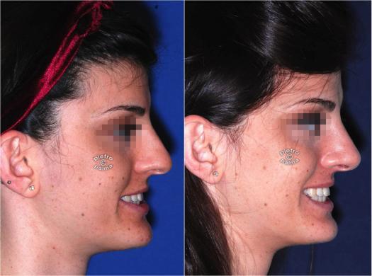 nose tip rhinoplasty before and after 2