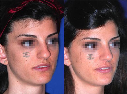 nose tip rhinoplasty before and after 3