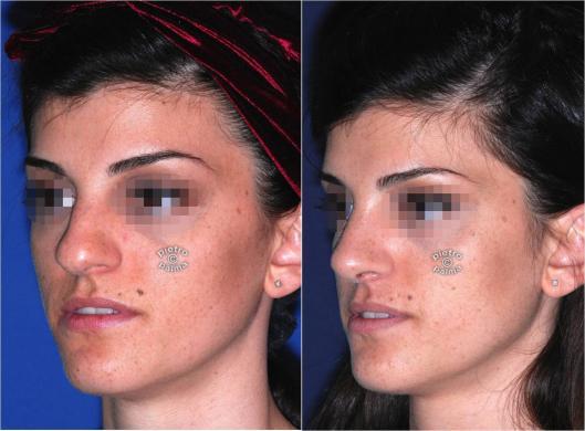 nose tip rhinoplasty before and after 4